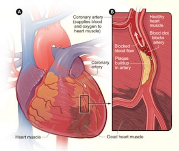 Massive Heart Attack - Definition, Causes, Survival Rates : Health Blog
